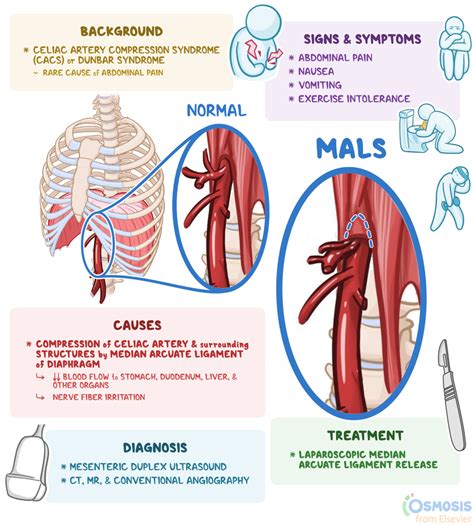 median arcuate ligament syndrome